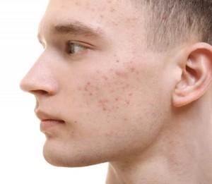 Вульгарные угри