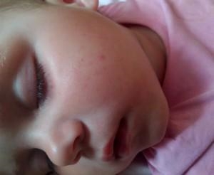 прыщи у новорожденных