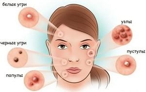 виды прыщей